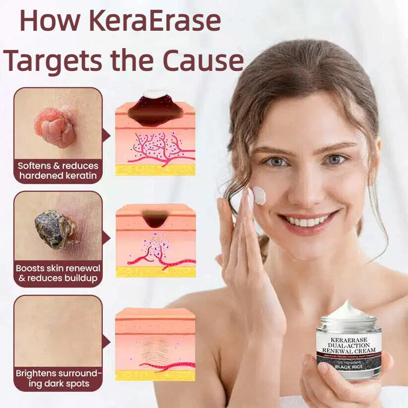 ✨Flash Sale - KeraErase Dual-Action Renewal Cream